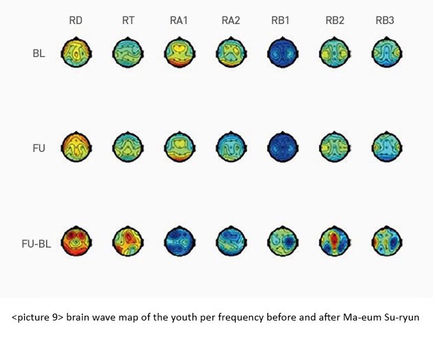 Altered Upper Alpha Brain Wave of Adolescents and Teachers – Meditation Effect
